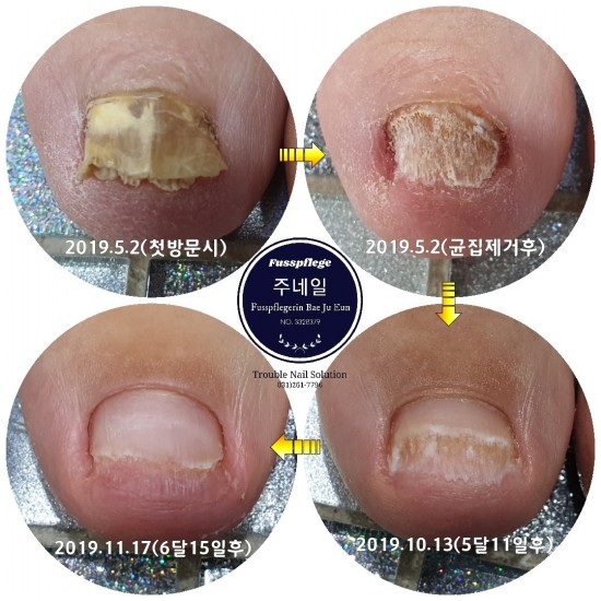 발톱무좀 무조건 가린다고 해결되지 않습니다./분당용인수원수지보정동백죽전동/주네일/무좀파고드는내향성발톱손톱변형전문네일샵