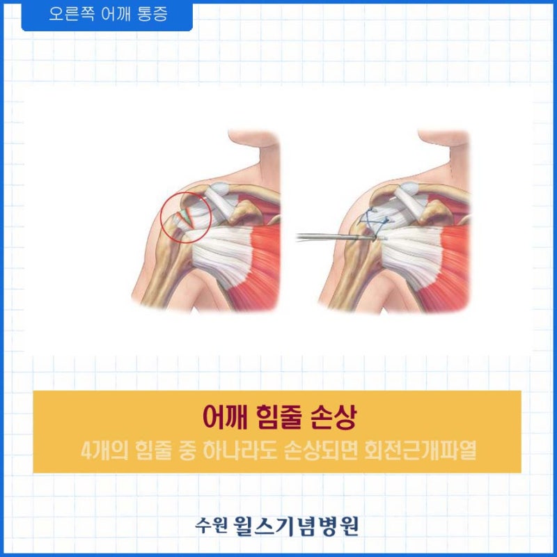 또한 오른쪽 어깨 통증의 원인을 찾고 계십니까?