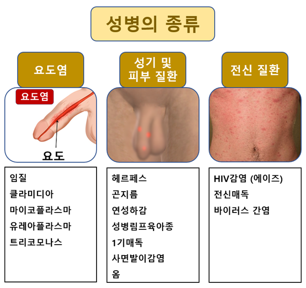  남자 성병의 종류와 진단/검사 방법