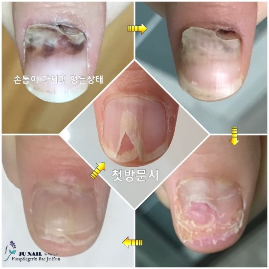 다쳐서 멍든손톱 빠진손톱 이렇게 될수도 있습니다./분당용인수원수지보정동백죽전동/주네일/무좀파고드는내향성발톱손톱변형전문네일샵 다쳐서 멍든손톱 빠진손톱 이렇게 될수도 있습니다./분당용인수원수지보정동백죽전동/주네일/무좀파고드는내향성발톱손톱변형전문네일샵