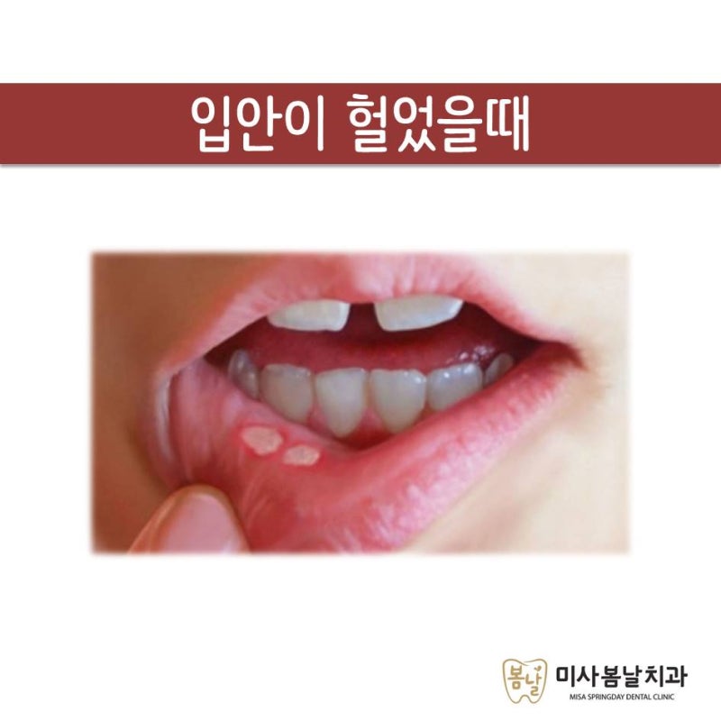 다양한 프로폴리스 제품 리뷰: 혀침이나 입안이 막혔을 때, 목이 부었을 때는 프로폴리스 스프레이가 가장 좋아요~!