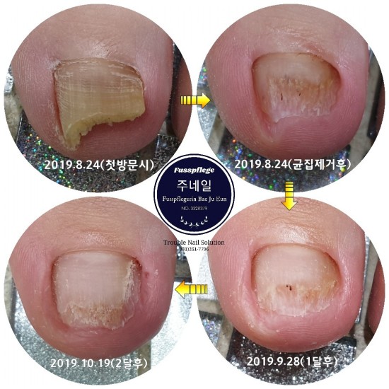 누렇고 파고들어 너무 아팠던 무좀발톱 이거 실화입니다/분당용인수원수지보정동백죽전동/주네일/무좀파고드는내향성발톱손톱변형전문네일샵 누렇고 파고들어 너무 아팠던 무좀발톱 이거 실화입니다/분당용인수원수지보정동백죽전동/주네일/무좀파고드는내향성발톱손톱변형전문네일샵