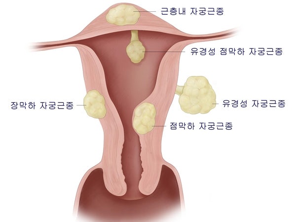 갑상선암의 원인으로 나타나는 갑상선 결절을 느끼신다면