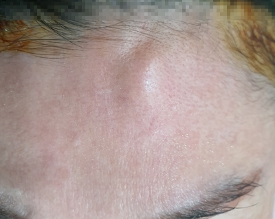 인천이마골종 , osteoma 인천이마골종 , osteoma