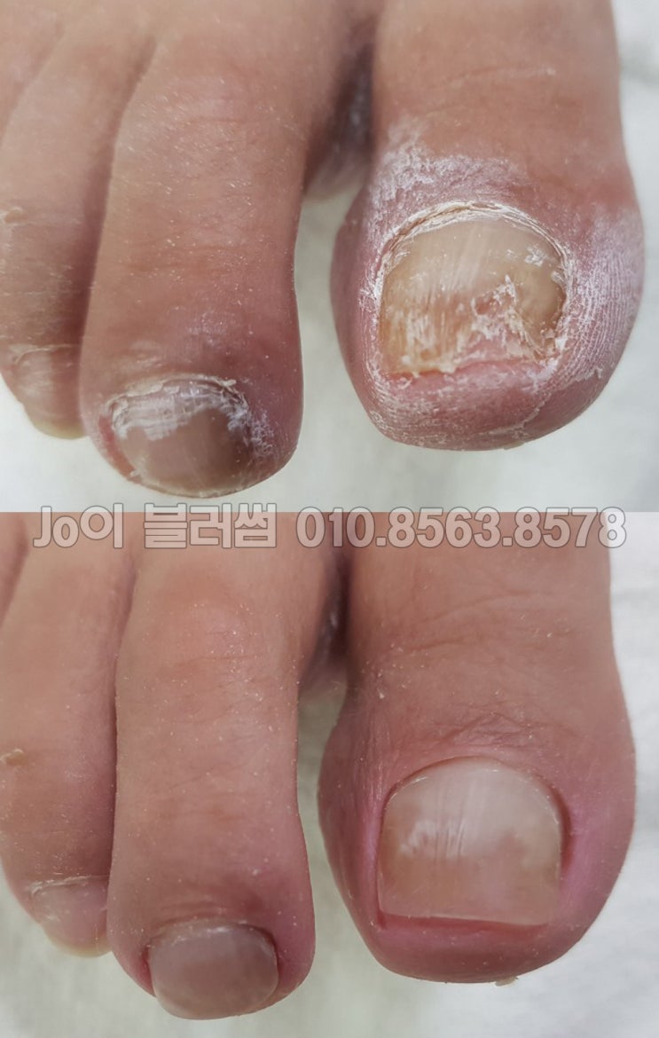  발톱이 떨어져 나가고, 파고들고, 들떠서 심각한 상태의 발톱무좀 등으로 고민하시는 모든 고객님들을 기다리고 있는 발톱관리전문네일샵 조이블러썸