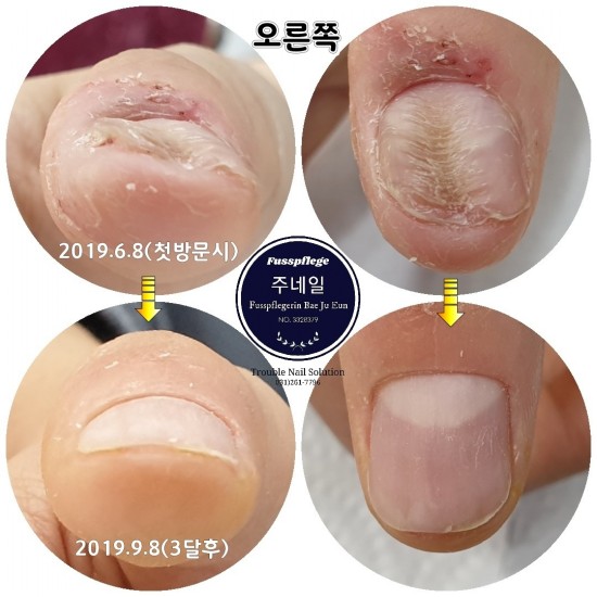 대전에서 먼길 달려와 물어뜯는손톱 빨래판손톱 3개월관리 끝~/분당용인수원수지보정동백죽전동/주네일/무좀파고드는내향성발톱손톱변형전문네일샵