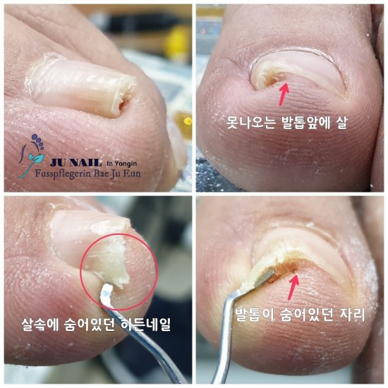 발톱을 다 잘라버리고 싶을정도의 고통을주는 내성발톱/분당용인수원수지보정동백죽전동/주네일/무좀파고드는내향성발톱손톱변형전문네일샵