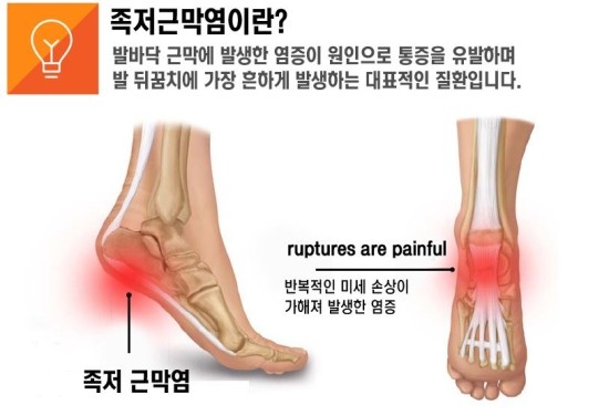 오른발 통증이 계속 보일 때 4