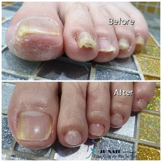 남자도 발톱무좀 관리하자구요/분당용인수원수지보정동백죽전동/주네일/무좀파고드는내향성발톱손톱변형전문네일샵 남자도 발톱무좀 관리하자구요/분당용인수원수지보정동백죽전동/주네일/무좀파고드는내향성발톱손톱변형전문네일샵