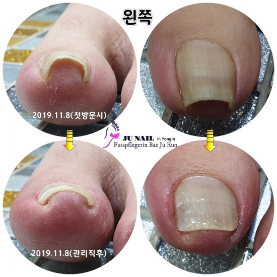 충북 충주에서 발톱이 파고들어 용인까지 찾아주셨어요./분당용인수원수지보정동백죽전동/주네일/무좀파고드는내향성발톱손톱변형전문네일샵 충북 충주에서 발톱이 파고들어 용인까지 찾아주셨어요./분당용인수원수지보정동백죽전동/주네일/무좀파고드는내향성발톱손톱변형전문네일샵