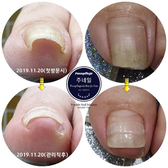 파고드는발톱(내성발톱)잘하는곳을 찾으신다면 용인 주네일 방문해주세요~~/분당용인수원수지보정동백죽전동/주네일/무좀파고드는내향성발톱손톱변형전문네일샵 파고드는발톱(내성발톱)잘하는곳을 찾으신다면 용인 주네일 방문해주세요~~/분당용인수원수지보정동백죽전동/주네일/무좀파고드는내향성발톱손톱변형전문네일샵