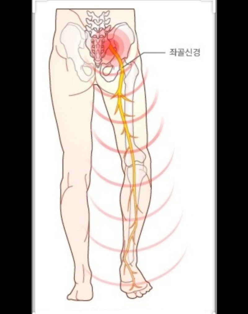 좌골신경통 관리방법 5