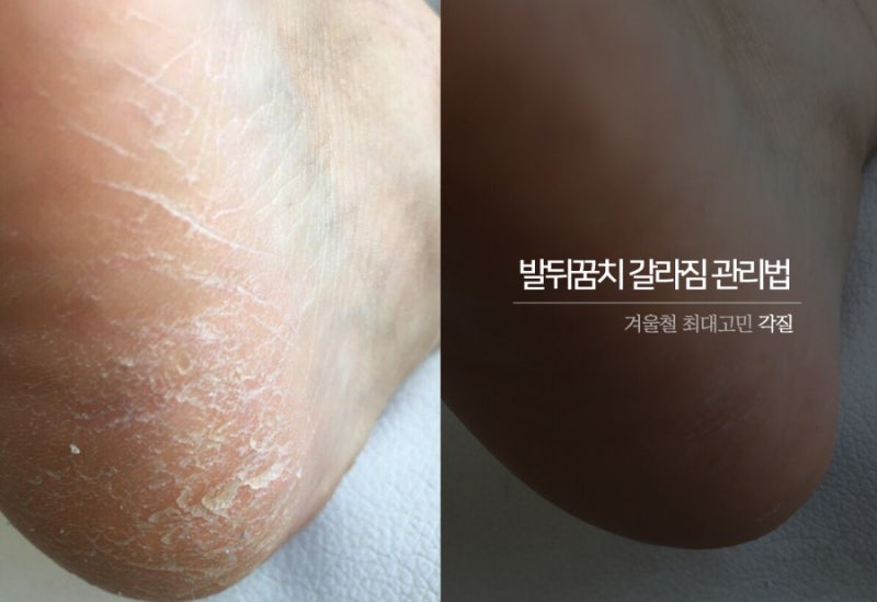 발 각화증 크림으로 관리했어요. 3