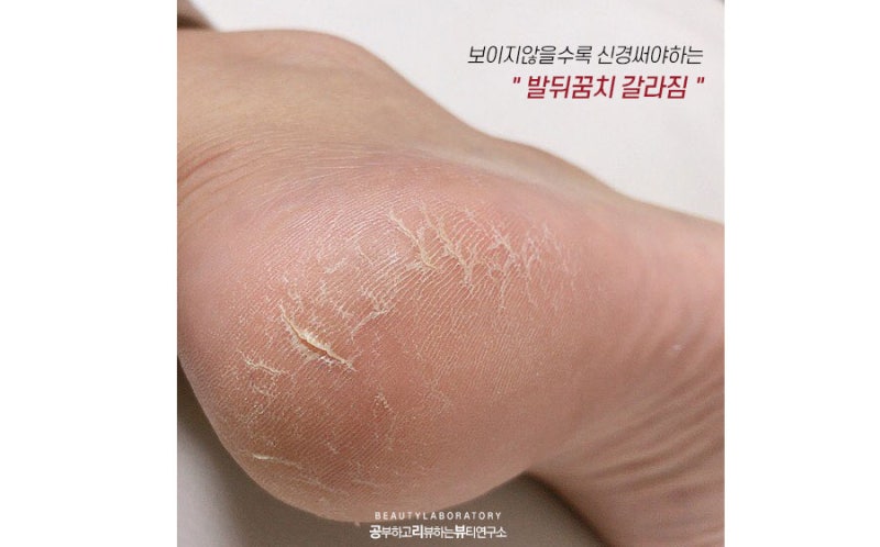 발뒤꿈치 갈라질 때까지 각질 제거 후 건조증을 이렇게