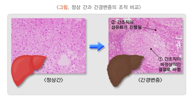  수원요양병원 : 간경화 - 복수천자 가능한 병원