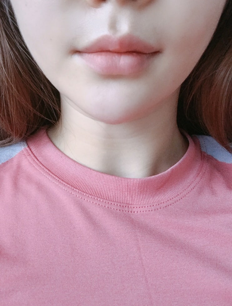  강남 민트실리프팅 시술후기!!