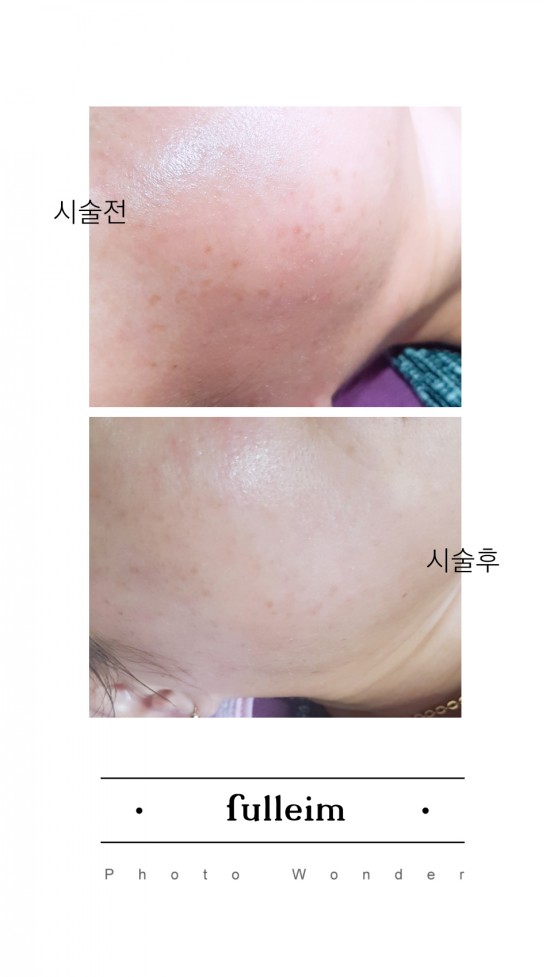  포승 피부관리 설렘 시술 전 후 사진