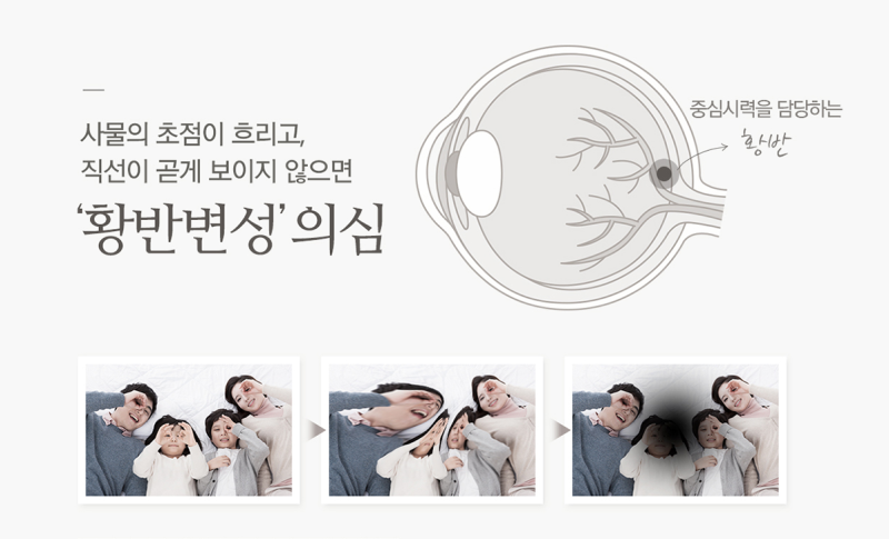 살아 있는 동안 안검 황종 수술이라는 것도 해본다 8