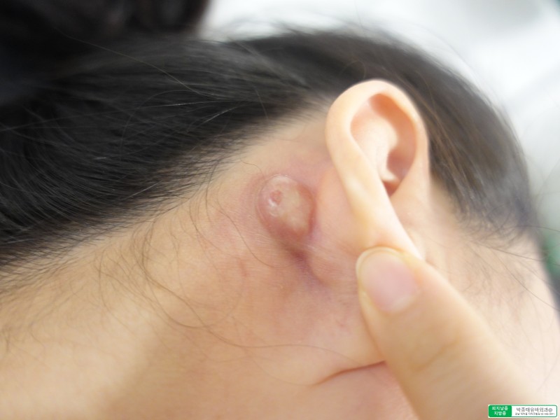 Dr.Park] 귀 뒤에 발생한 표피낭종.. 제거 수술 외과 병원 : 네이버 블로그