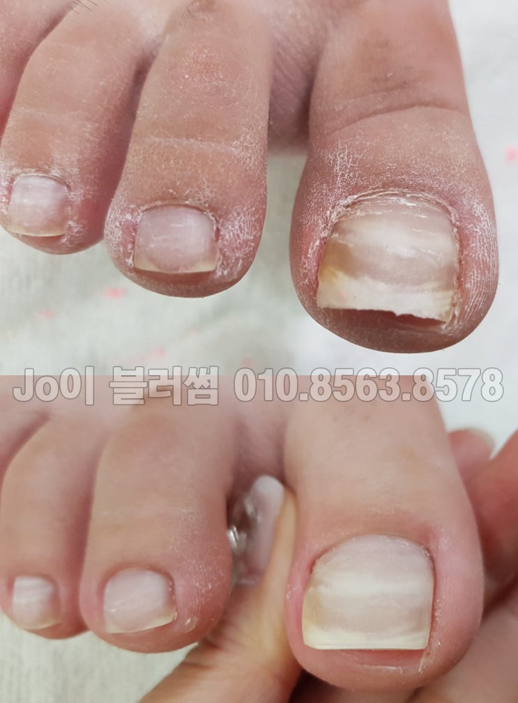  용인 발톱무좀으로 고생하시는 고객님들의 집중적 관리 전문네일샵 조이블러썸