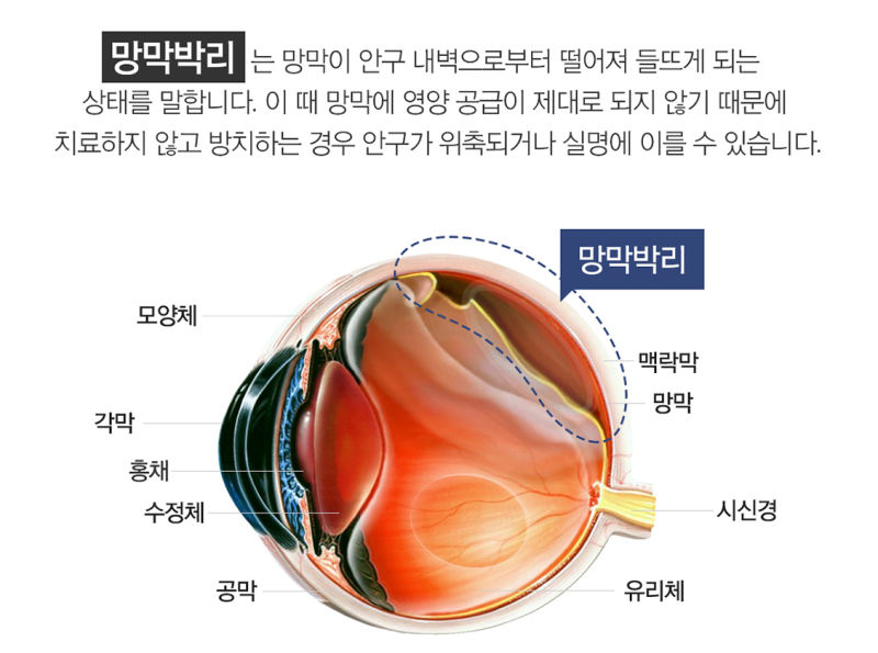 살아 있는 동안 안검 황종 수술이라는 것도 해본다 10