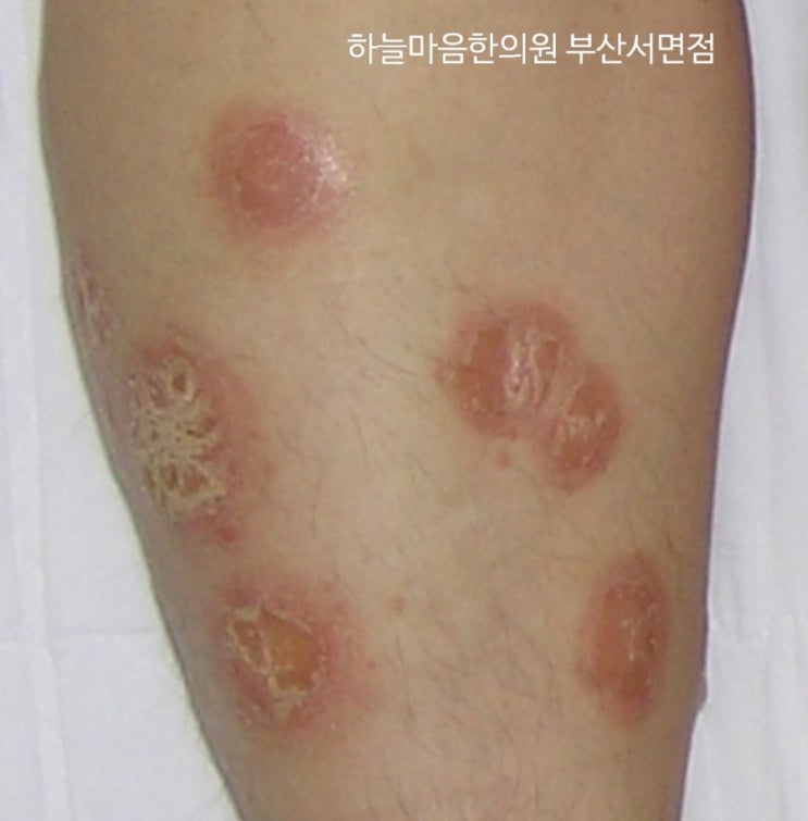  건선의 치유 모습  Natural Treatment of psoriasis