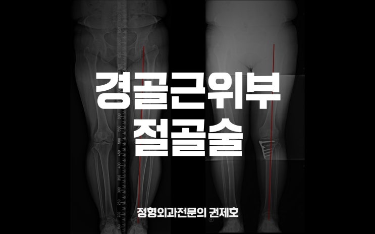  경골근위부절골술, 무릎은 소중하니까