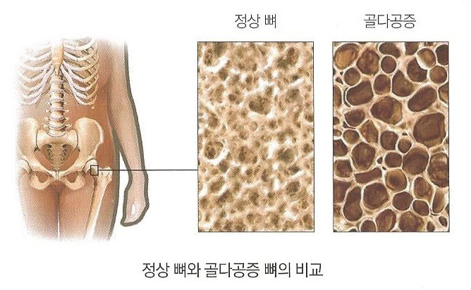  대전 중구 대흥동 선화동 은행동 헬스장 가온헬스 운동과 골밀도(키성장)