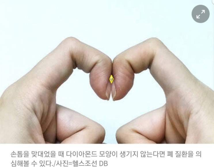  손가락으로 '이 모양' 안 나오면, 폐암 가능성
