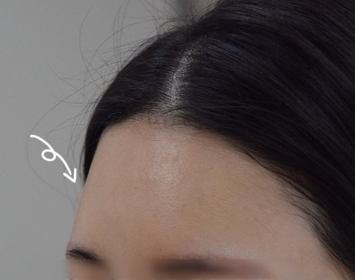 이마 필러 부작용, 시술 시 꼭 고려해야 할 사항은? 5