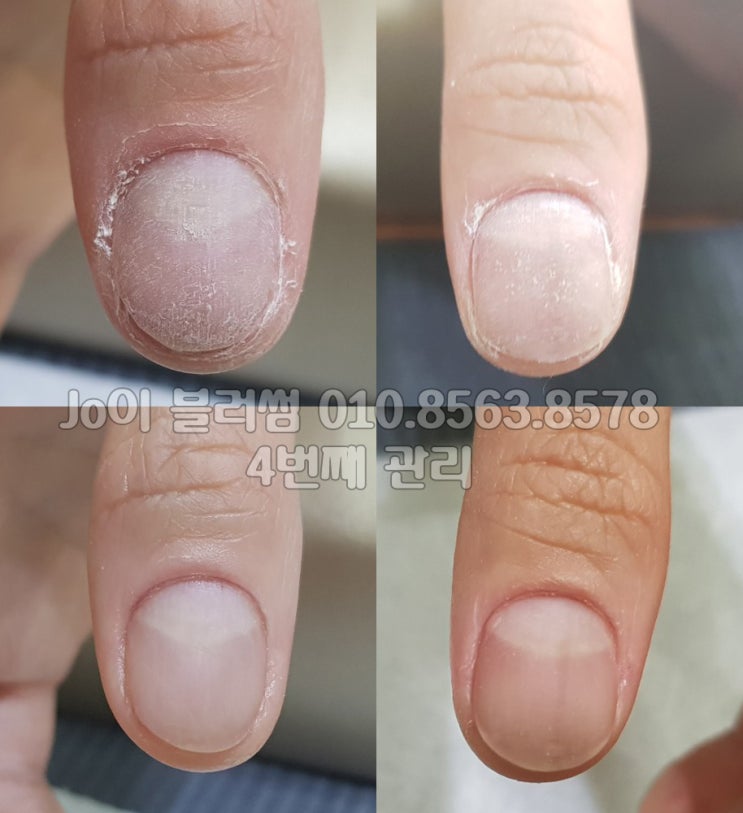  용인 손톱 변형, 손톱 망가짐으로 고민하는 고객님을 관리하고 시술해주는 유명네일샵 조이블러썸