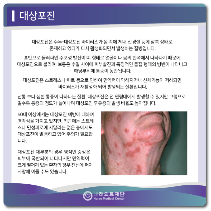 대상포진 증상(초기) 및 원인과 5
