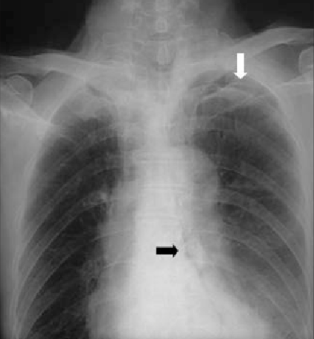 가슴통증(흉통)을 호소하는 환자의 다양한 영상소견(Chest x-ray, chest ct) : 네이버 블로그
