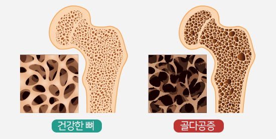  [골다공증에 좋은 음식] 골다공증 증상과 치료 & 좋은 음식 알려드립니다.(+ 골다공증 예방, 골다공증 치료, 골다공증 검사, 골다공증 진단, 골다공증 문헌고찰)