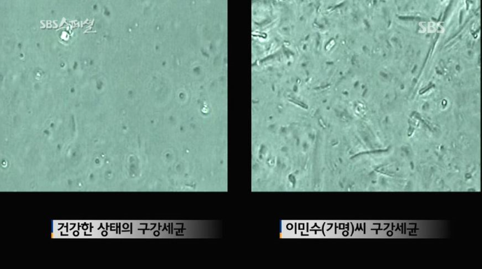  [펌] 심한 입냄새로 이혼 당한 남자의 입냄새 고치는 SBS 다큐