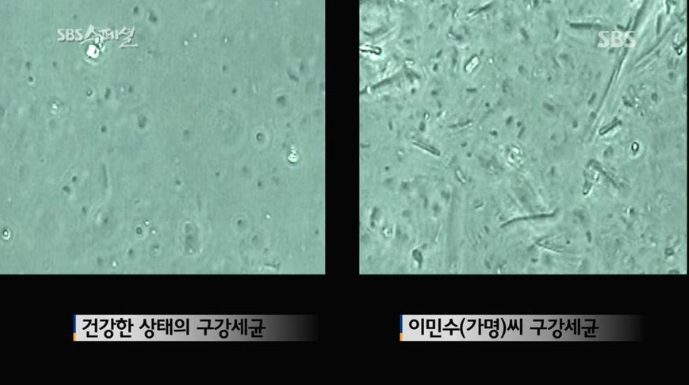 [펌] 심한 입냄새로 이혼 당한 남자의 입냄새 고치는 SBS 다큐