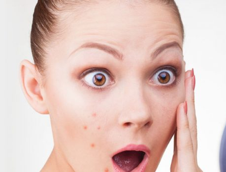  [여드름(Acne)종류 원인 치료법]1.여드름의 종류