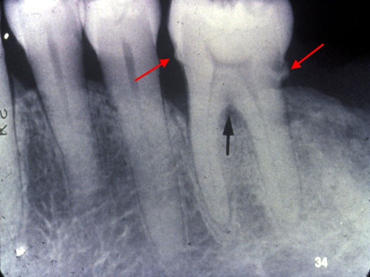 신대방동 치과에서 시행하는  잇몸병(치주염) 검사 방법