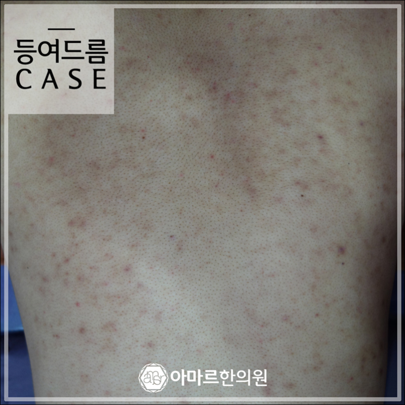여기저기 몸에 생기는 붉은반점 .. 적절한 대처는? : 네이버 블로그