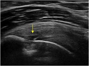 [통증/어깨] 회전근개파열(Rotator cuff tear(=RCT)) : 네이버 블로그