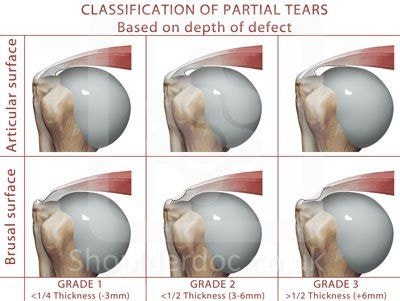 [통증/어깨] 회전근개파열(Rotator cuff tear(=RCT)) : 네이버 블로그