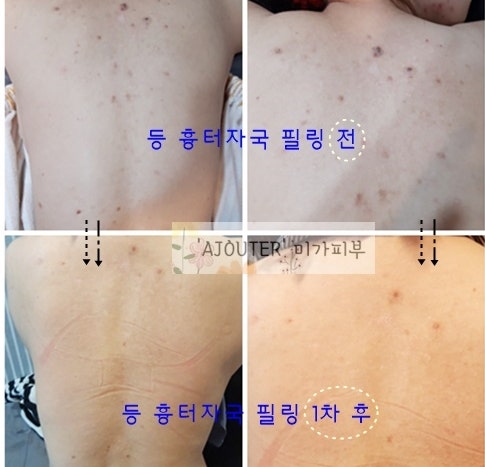 대전 여드름 스킨케어 알라딘 필링 오늘 스킨