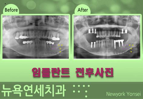  뼈이식 임플란트 수술은 무통 마취로 아프지 않게 받는 방법!