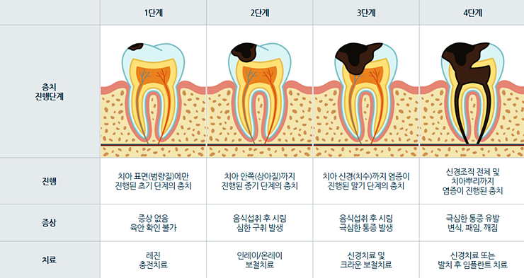  충치치료 1단계 [레진 치료]