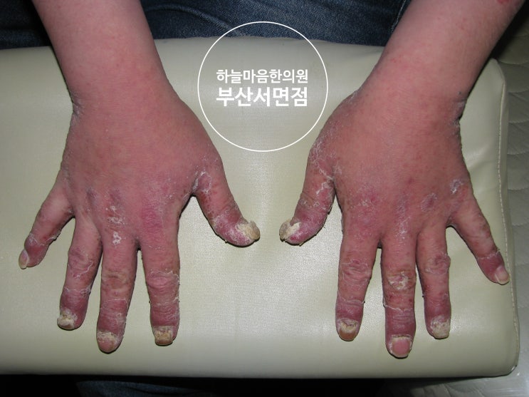  조갑건선의 치유 모습  Natural Treatment of fingernails psoriasis