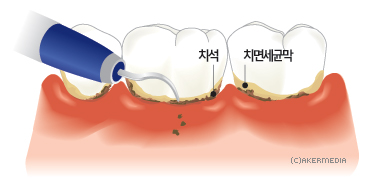  풍치 예방의 시작 스케일링으로