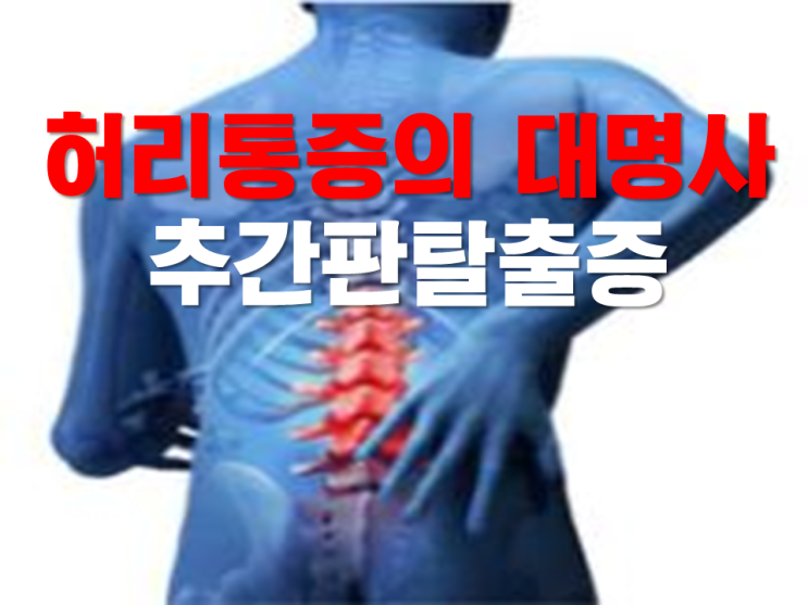  허리디스크(추간판탈출증)척추교정에 좋은 자세 운동과 신발 추천