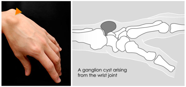 손등에 혹이 만져지는 손목 결절종의 증상과 치료는?