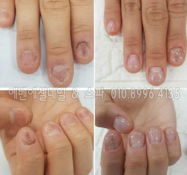  안산 물어뜯는 손톱의 손톱 성형, 변형 손톱도 손톱 성형이 가능한 제대로 관리하는 네일샵 에벤에셀 네일 & 스파