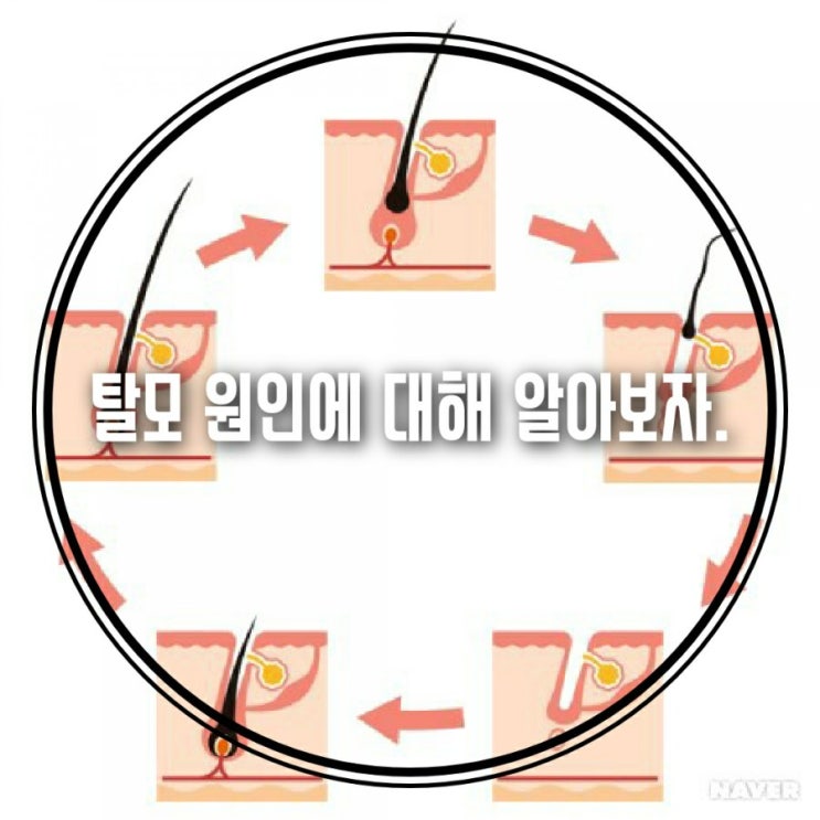  탈모 원인에 대해 알아보자.
